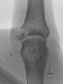 إصلاح أربطة مفصل إبهام اليد (MCP): دليل شامل للمرضى مع الأستاذ الدكتور محمد هطيف