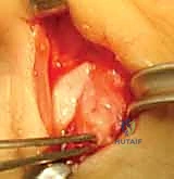 صورة توضيحية لـ إصلاح أربطة مفصل إبهام اليد (MCP): دليل شامل للمرضى مع الأستاذ الدكتور محمد هطيف