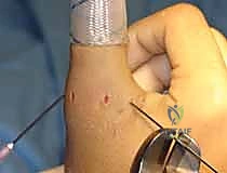 صورة توضيحية لـ إصلاح أربطة مفصل إبهام اليد (MCP): دليل شامل للمرضى مع الأستاذ الدكتور محمد هطيف