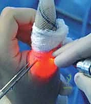 صورة توضيحية لـ إصلاح أربطة مفصل إبهام اليد (MCP): دليل شامل للمرضى مع الأستاذ الدكتور محمد هطيف