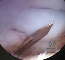 أعراض تمزق أربطة الإبهام