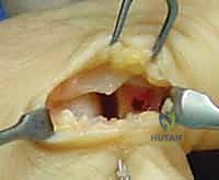 الفحص السريري والتشخيص الإشعاعي لمفصل الإبهام