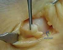 صورة طبية: إصلاح أربطة مفصل إبهام اليد (MCP): دليل شامل للمرضى مع الأستاذ الدكتور محمد هطيف