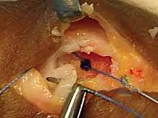 صورة توضيحية لـ إصلاح أربطة مفصل إبهام اليد (MCP): دليل شامل للمرضى مع الأستاذ الدكتور محمد هطيف