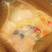 Illustration of collateral ligament disruptions - Dr. Mohammed Hutaif