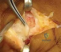 صورة توضيحية لـ إصلاح أربطة مفصل إبهام اليد (MCP): دليل شامل للمرضى مع الأستاذ الدكتور محمد هطيف