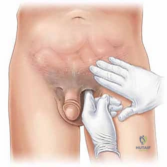 التشريح الطبي لمنطقة الأربية والفتق الرياضي