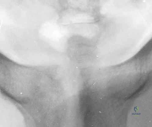 أسباب وعوامل خطر الإصابة بألم العانة الرياضي