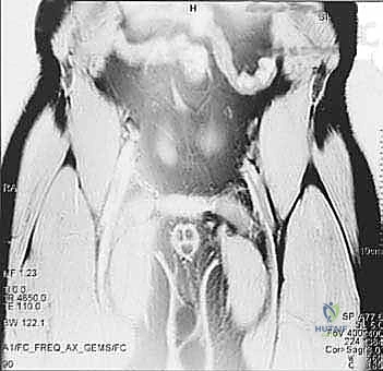 الأعراض السريرية للفتق الرياضي وألم الأربية