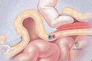 استخدام التصوير بالرنين المغناطيسي لتشخيص ألم العانة