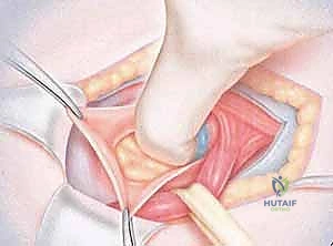 خطوات التدخل الجراحي للفتق الرياضي