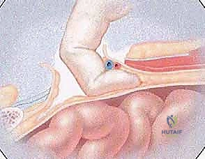 العلاج التحفظي والعلاج الطبيعي للفتق الرياضي