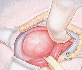 التشخيص التفريقي والفحص السريري الدقيق للفتق الرياضي