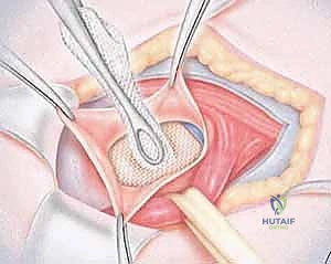 تقنية الشبكة المزدوجة المتقدمة في جراحة ألم العانة