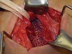 صورة توضيحية لـ جراحة الفتق الرياضي المتقدمة بالشبكة المزدوجة مع الأستاذ الدكتور محمد هطيف في صنعاء