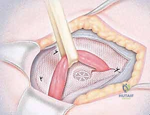 صورة توضيحية لـ جراحة الفتق الرياضي المتقدمة بالشبكة المزدوجة مع الأستاذ الدكتور محمد هطيف في صنعاء