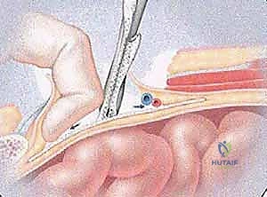 جراحة الفتق الرياضي المتقدمة بالشبكة المزدوجة مع الأستاذ الدكتور محمد هطيف في صنعاء
