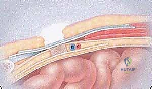 صورة توضيحية لـ جراحة الفتق الرياضي المتقدمة بالشبكة المزدوجة مع الأستاذ الدكتور محمد هطيف في صنعاء