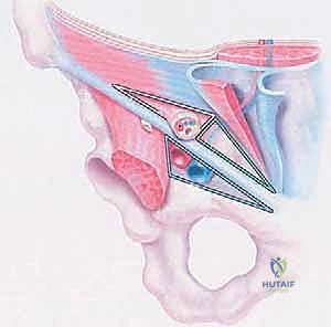 صورة توضيحية لـ جراحة الفتق الرياضي المتقدمة بالشبكة المزدوجة مع الأستاذ الدكتور محمد هطيف في صنعاء