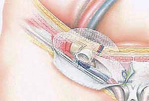 صورة توضيحية لـ جراحة الفتق الرياضي المتقدمة بالشبكة المزدوجة مع الأستاذ الدكتور محمد هطيف في صنعاء