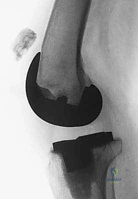 صورة توضيحية لـ إعادة بناء وتر الرضفة بعد جراحة استبدال الركبة الكلي باستخدام وتر أخيل