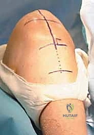 التشريح الدقيق لآلية الباسطة للركبة