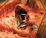 صورة توضح التمزق والخلل الميكانيكي في الركبة