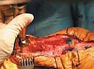 تجهيز السرير العظمي في عظمة الساق