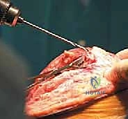 التشخيص الإشعاعي لتمزق الوتر