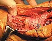 تثبيت الكتلة العظمية بالبراغي