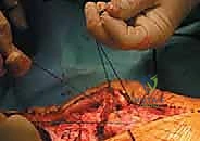 إدخال وتشكيل الكتلة العظمية