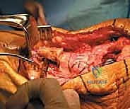 بداية الإجراء الجراحي وكشف المفصل