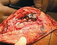 تجهيز الطعم الخيفي لوتر أخيل مع الكتلة العظمية