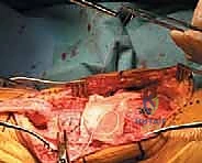 صورة توضيحية لـ إعادة بناء وتر الرضفة بعد جراحة استبدال الركبة الكلي باستخدام وتر أخيل: حلول متقدمة مع الأستاذ الدكتور محمد هطيف في صنعاء