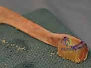 صورة توضيحية لـ إعادة بناء وتر الرضفة بعد جراحة استبدال الركبة الكلي باستخدام وتر أخيل: حلول متقدمة مع الأستاذ الدكتور محمد هطيف في صنعاء