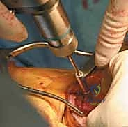 Revision Total Knee Arthroplasty with Extensor Mechanism Reconstruction: An Achilles Allograft Masterclass