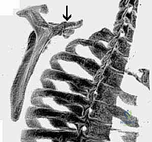 التشوهات العظمية المسببة لمتلازمة الكتف الطرقعي