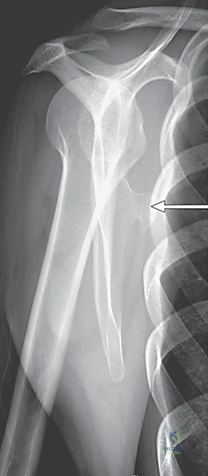 صورة توضيحية لـ متلازمة الكتف الطرقعي: دليل شامل للعلاج والتعافي مع الأستاذ الدكتور محمد هطيف