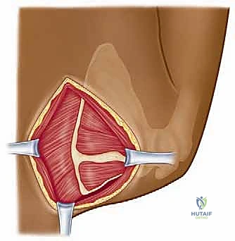 الأشعة المقطعية ثلاثية الأبعاد لتقييم عظام الكتف
