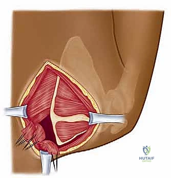 متلازمة الكتف الطرقعي: دليل شامل للعلاج والتعافي مع الأستاذ الدكتور محمد هطيف