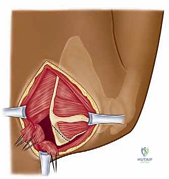 صورة توضيحية لـ متلازمة الكتف الطرقعي: دليل شامل للعلاج والتعافي مع الأستاذ الدكتور محمد هطيف