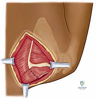 صورة توضيحية لـ متلازمة الكتف الطرقعي: دليل شامل للعلاج والتعافي مع الأستاذ الدكتور محمد هطيف