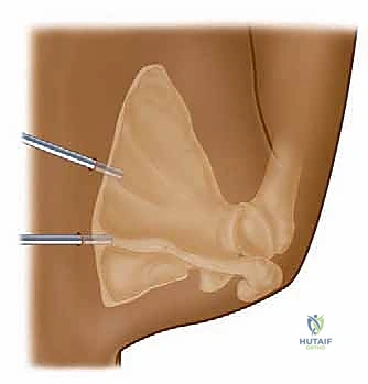 صورة طبية: متلازمة الكتف الطرقعي: دليل شامل للعلاج والتعافي مع الأستاذ الدكتور محمد هطيف