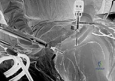 Illustration of snapping scapula syndrome - Dr. Mohammed Hutaif