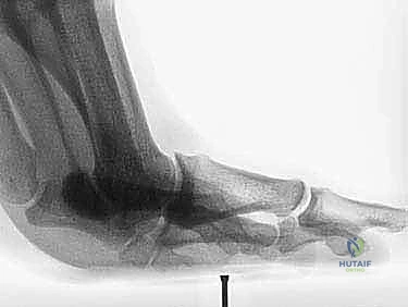 التصوير بالرنين المغناطيسي لتشخيص التمزق