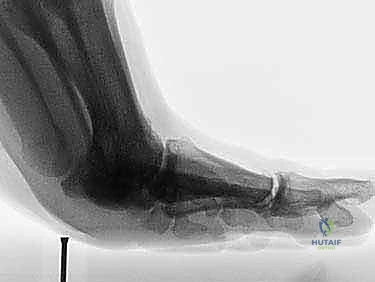 التصوير بالأشعة السينية لتقييم العظام