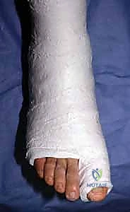 التشريح الدقيق لمفصل إبهام القدم