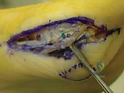 تقنيات الأشرطة اللاصقة والعلاج التحفظي