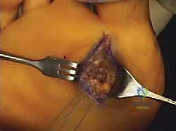 استخدام الأحذية الطبية والتثبيت