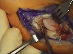 تأثير الأحذية والأسطح على مفصل الإبهام